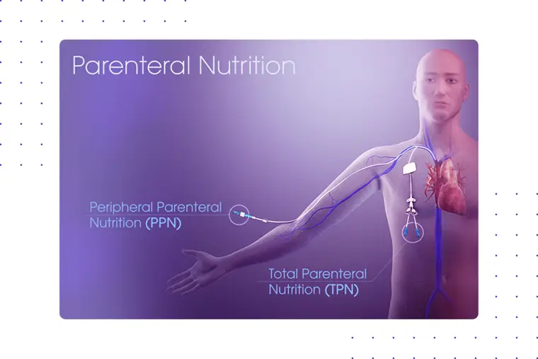 Understanding Parenteral Nutrition